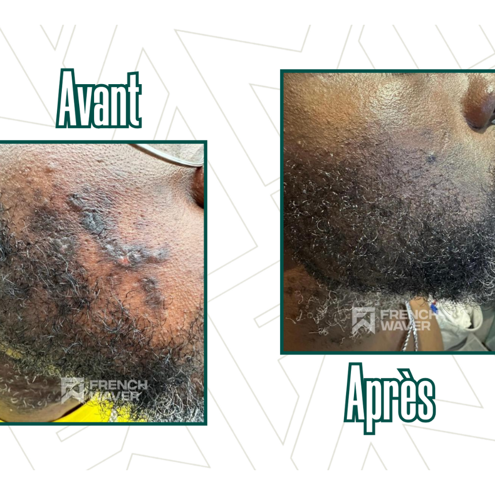 Kit de Soin Anti Poils incarnés