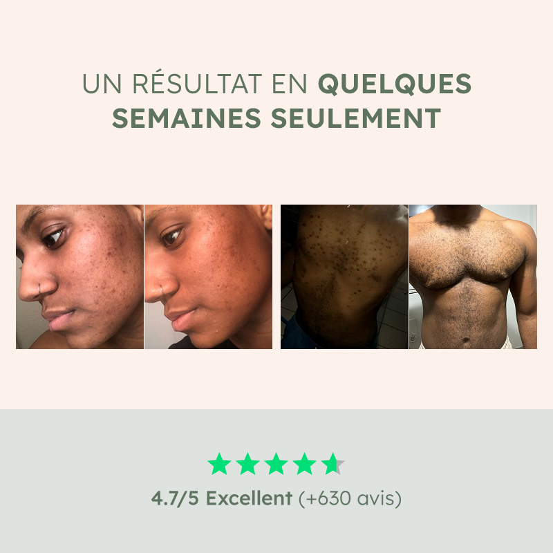 Kit de Soin Anti Poils incarnés