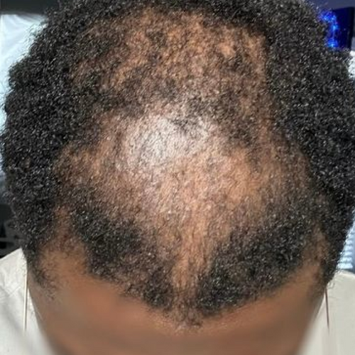 Perte de cheveux & perte de densité capillaire