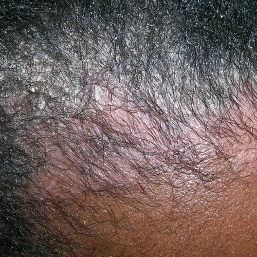 Perte de cheveux & perte de densité capillaire
