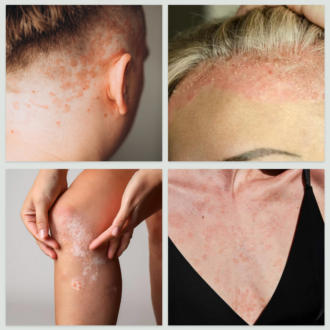 Baume Anti-Psoriasis