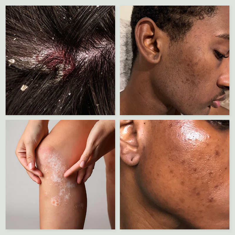 Psoriasis & Dermatite Séborrhéique