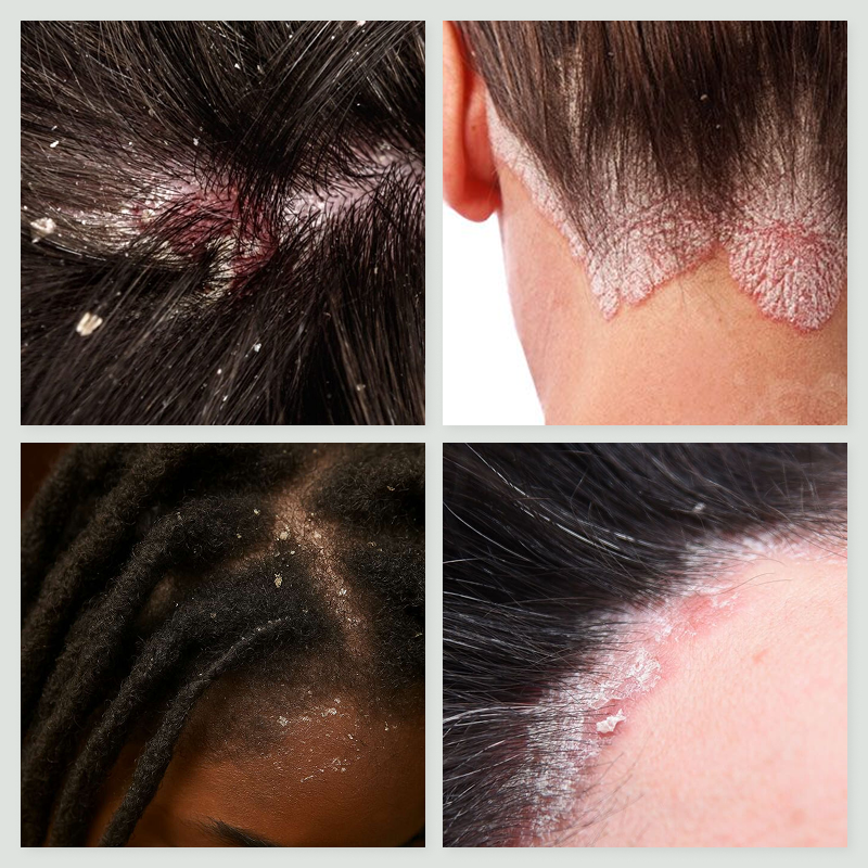 Psoriasis & Dermatite Séborrhéique