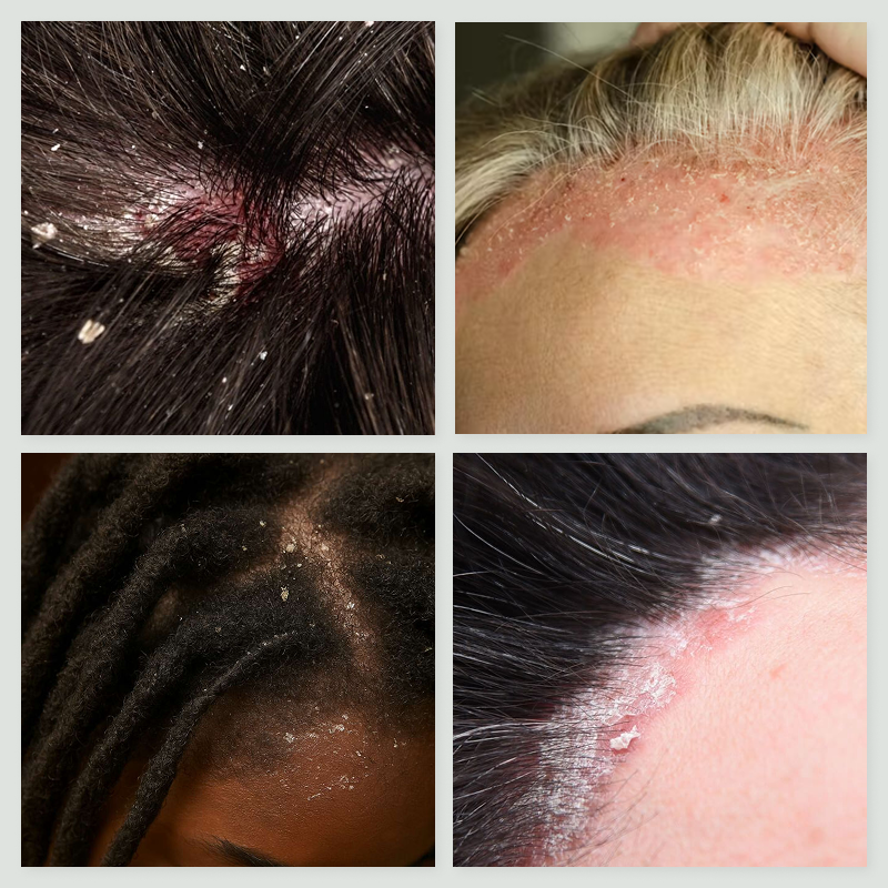 Psoriasis & Dermatite Séborrhéique