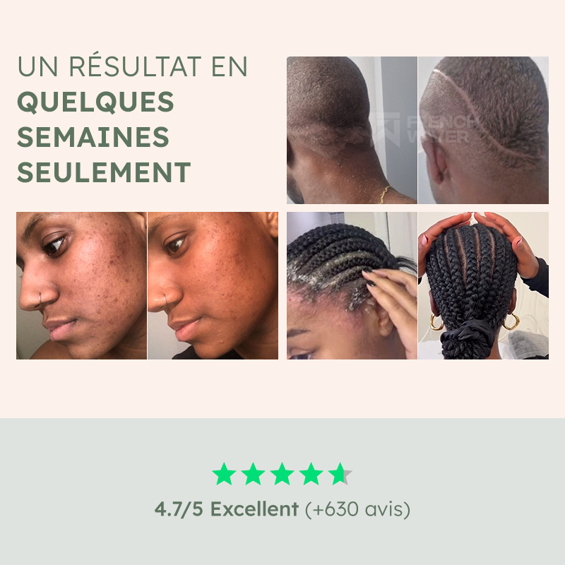 Psoriasis & Dermatite Séborrhéique