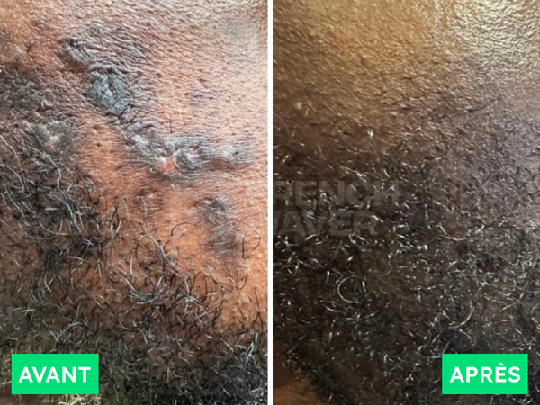 Avant / Après de Siméon K.