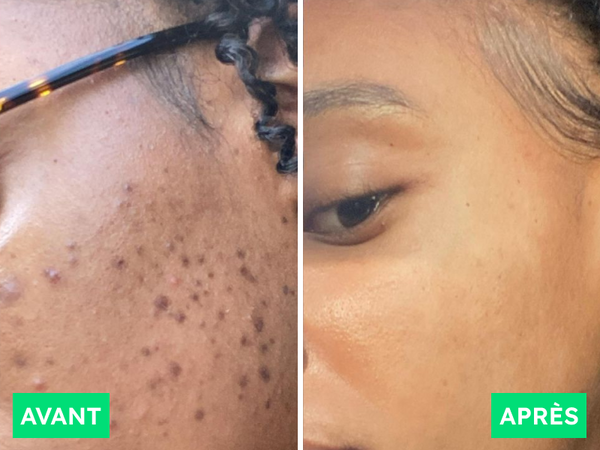 Avant / Après de Aïcha B.