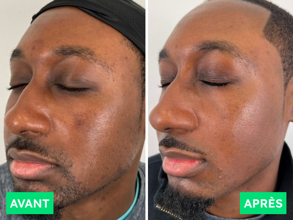 Avant / Après de Abdoulaye M.