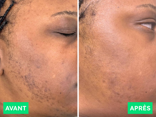 Avant / Après de Fatou N.