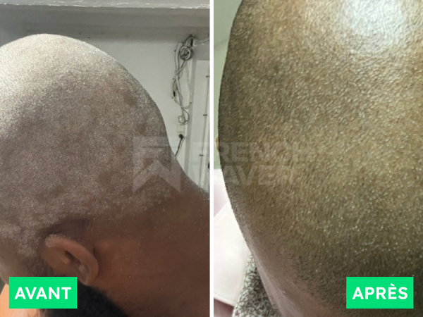 Avant / Après de Kévin M.