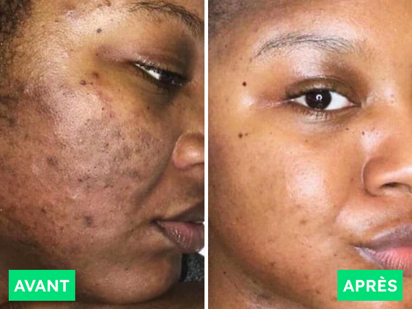 Avant / Après de Aïcha D.