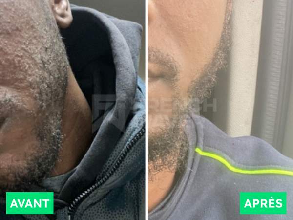 Avant / Après de Yanis B.