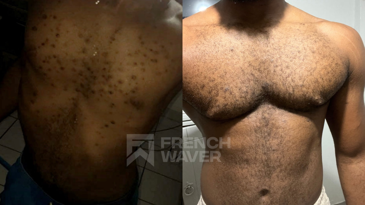 Kit de Soin Anti Poils incarnés