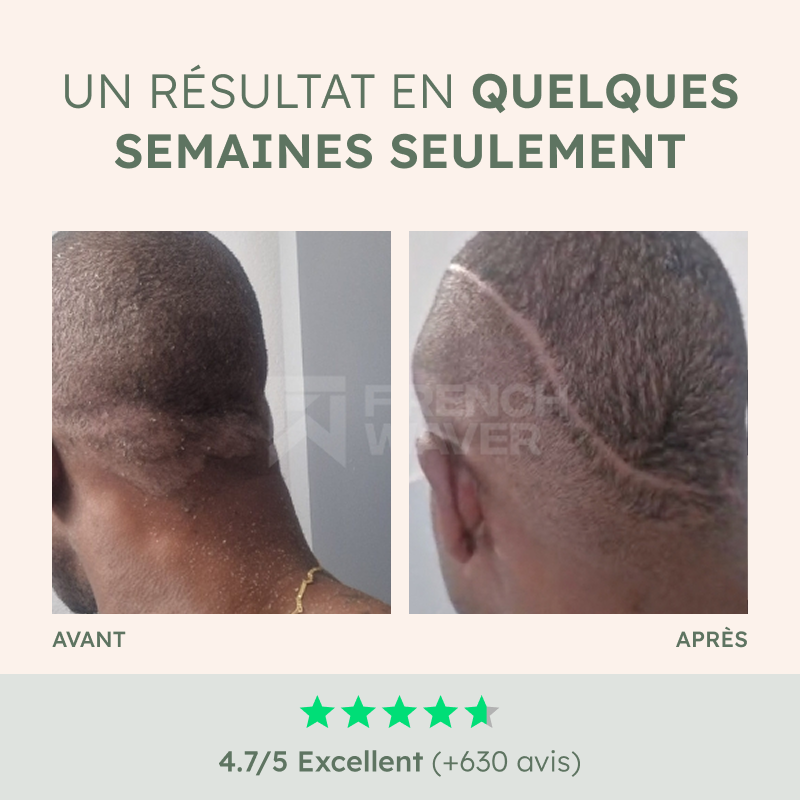 Shampoing Anti-Psoriasis