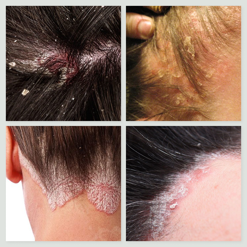 Shampoing Anti-Psoriasis