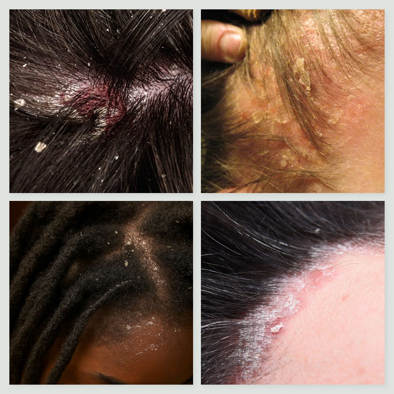 Shampoing Anti-Psoriasis